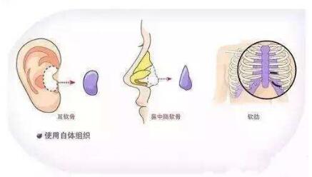 隆鼻材料到底應(yīng)該怎么選?