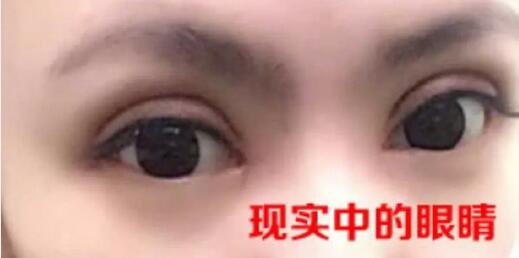 歐式雙眼皮果圖