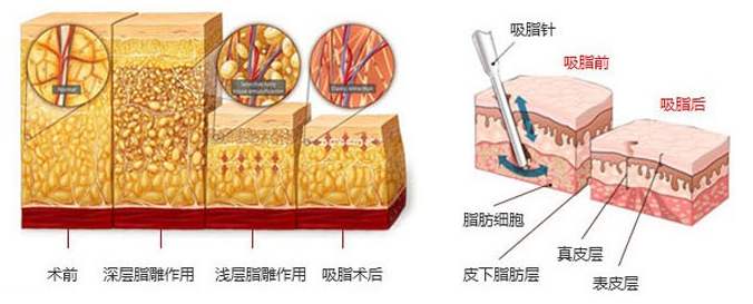 臀部吸脂有什么好處?