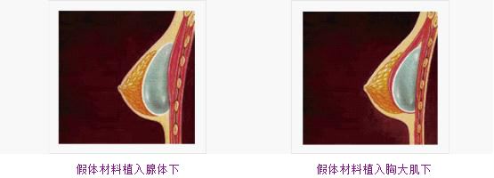 妙桃假體隆胸術前注意事項：