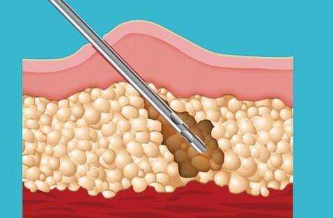 瘦后背的方法有哪些？