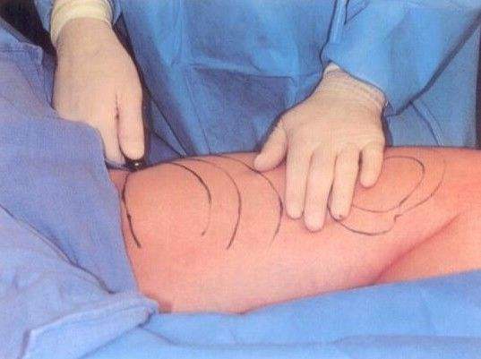 大腿吸脂分以下幾個步驟：