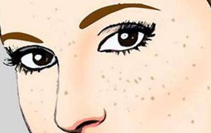 激光祛黃褐斑的優(yōu)勢(shì)