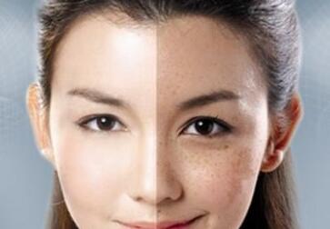 激光祛黃褐斑的優(yōu)勢(shì)