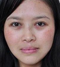 激光祛黃褐斑的優(yōu)勢(shì)