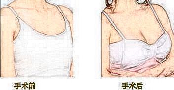 妙桃假體隆胸術前注意事項：