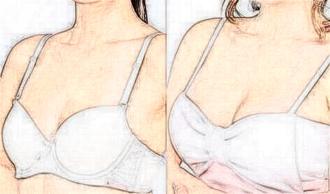 妙桃假體隆胸術前注意事項：