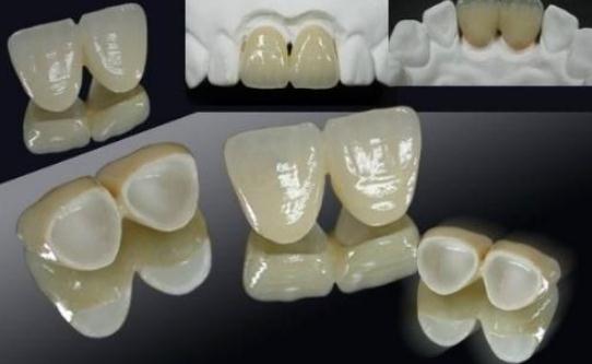 做美牙冠步驟：