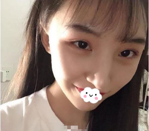 分享一組磨骨手術(shù)對(duì)比照片，還有親身感受經(jīng)歷！