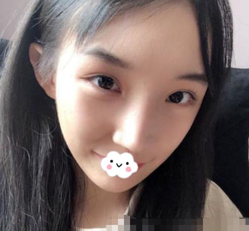 磨骨術(shù)后果