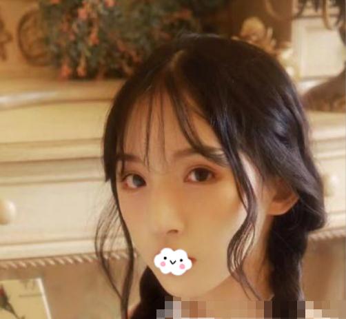 磨骨術(shù)后案例分享