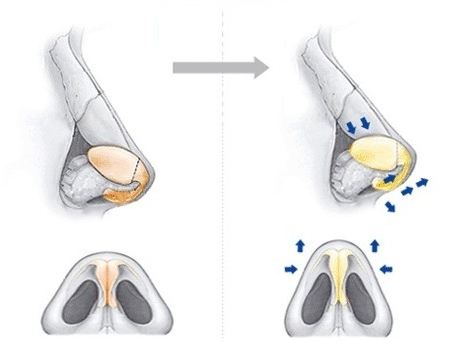 鼻尖成形術的優(yōu)點：