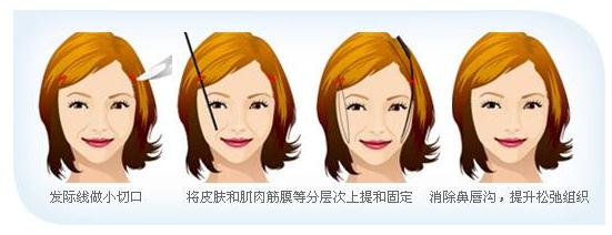 內(nèi)窺鏡除皺術(shù)原理分析