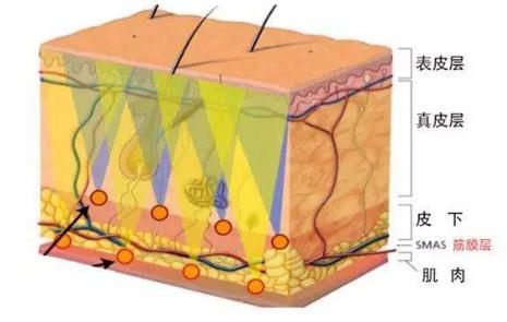 內(nèi)窺鏡除皺術(shù)的優(yōu)點(diǎn)