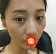 藍(lán)寶石激光祛斑來拯救我這個(gè)斑點(diǎn)女孩！