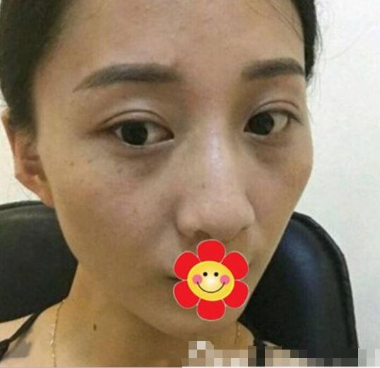 藍(lán)寶石激光祛斑來拯救我這個(gè)斑點(diǎn)女孩(圖)