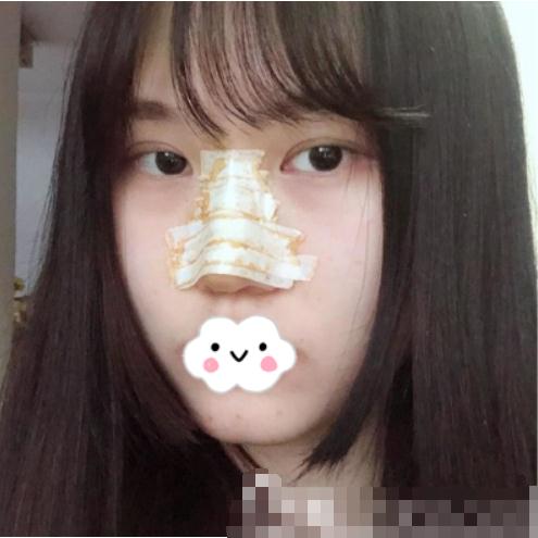 隆鼻術(shù)后第3天