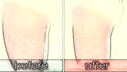 大腿吸脂手術都有以下優(yōu)勢：