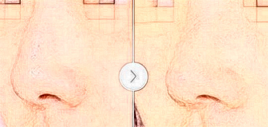 駝峰鼻是怎樣矯正的？