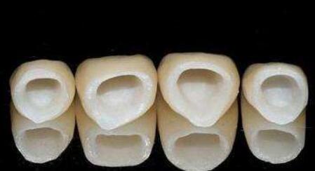 做美牙冠步驟：