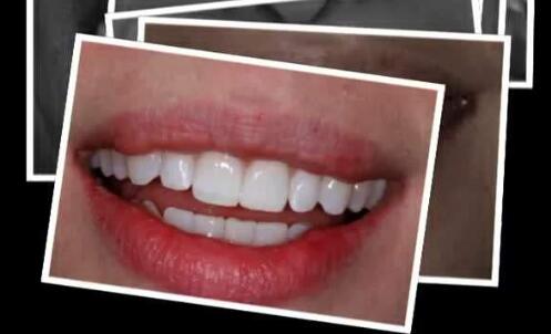 美牙冠是什么？