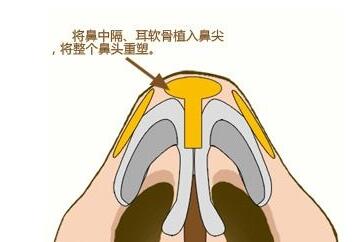 鼻尖成形術的原理