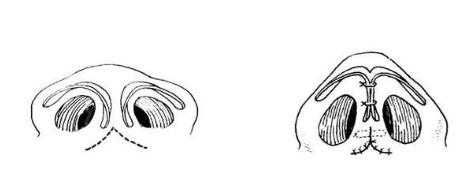 鼻尖成形術的原理