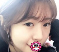 長(zhǎng)沙愛**張姣姣雙眼皮案例圖~美眼殺傷力真強(qiáng)