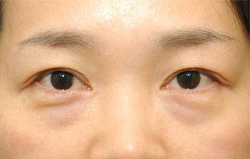 年紀輕輕就有眼袋？外切去眼袋手術(shù)真的應該了！