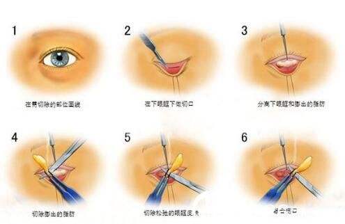 外切去眼袋手術(shù)的優(yōu)點