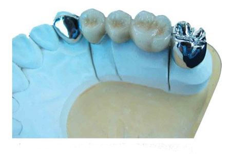 純鈦烤瓷牙的缺點