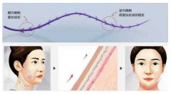 埋線除皺是什么？讓你遠(yuǎn)離皺紋沒煩惱！