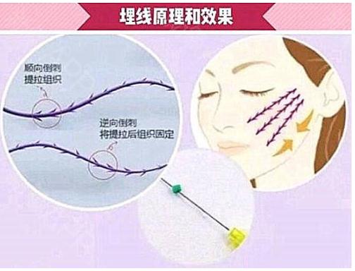埋線除皺的優(yōu)勢