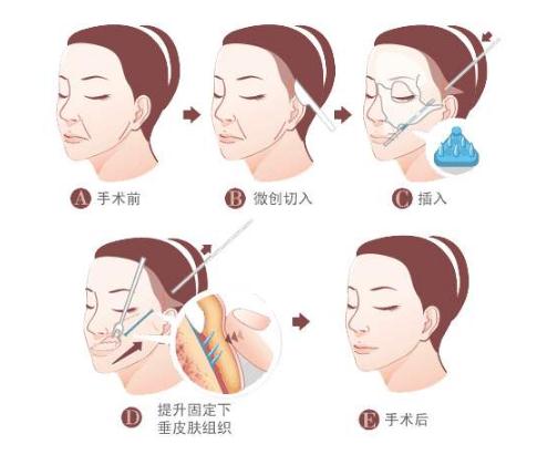 埋線除皺的注意事項