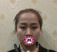 做完仿生隆鼻手術(shù)的果~顏值即正義！