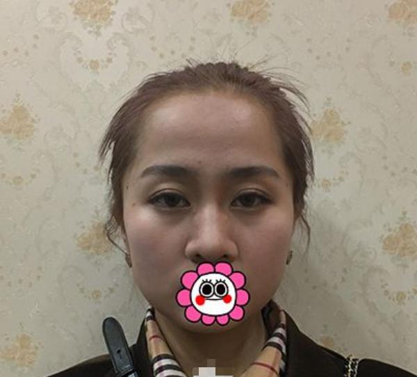 做完仿生隆鼻手術(shù)的果~顏值即正義！