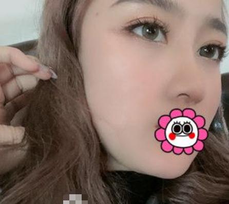 隆鼻術(shù)后第14天