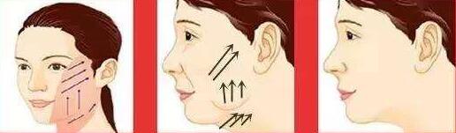 埋線除皺的優(yōu)勢