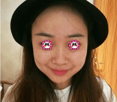 像素激光去痘做完后已經(jīng)6個(gè)月了！無暇肌膚！