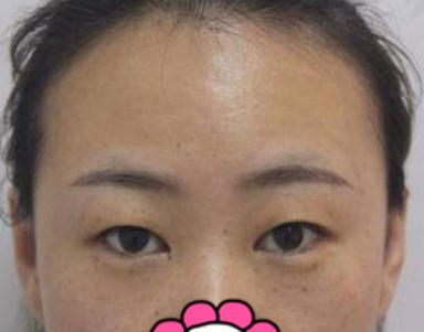 埋線雙眼皮手術(shù)的果圖&nbsp;及過程解析圖