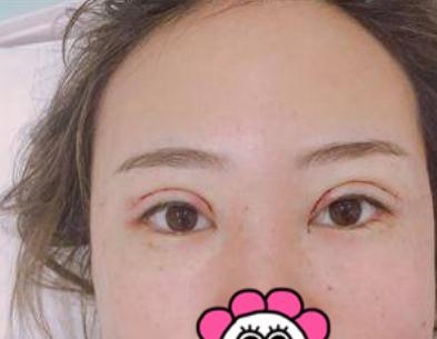 埋線雙眼皮術(shù)后第4天