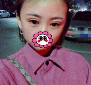 埋線雙眼皮術(shù)后第13天