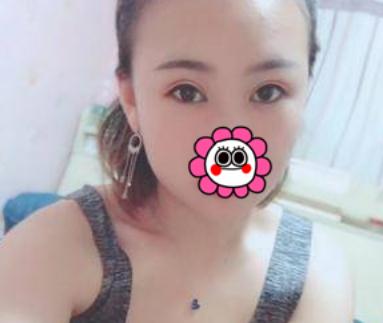 埋線雙眼皮術(shù)后第34天