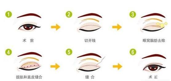 埋線雙眼皮術(shù)后第13天