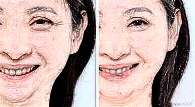 去魚尾紋的方法有哪些？