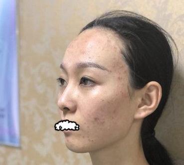 妹子做果酸換膚對比圖~嫩膚界的愛馬仕~