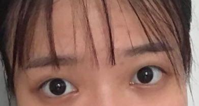 雙眼皮手術(shù)術(shù)前
