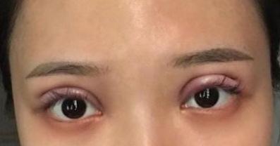 雙眼皮手術(shù)術(shù)后