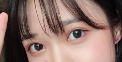 雙眼皮手術(shù)術(shù)后第67天