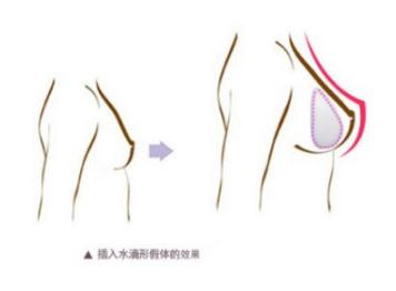 什么樣的人群適合做水滴假體？